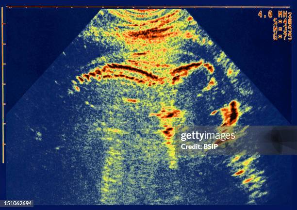 Cystic Hygroma Or Cystic Lymphangioma Detected On The Neck Of A Fetus At The Occasion Of The Control Of The Vertebral Column. Cystic Hygromas Are...