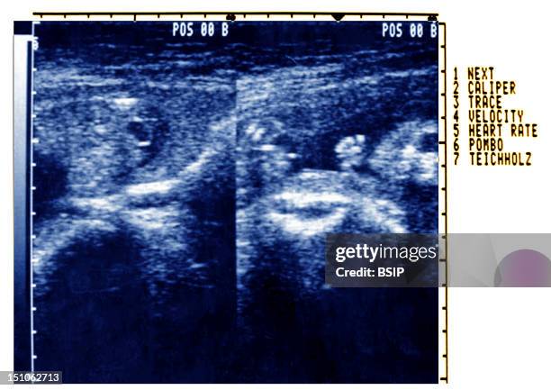 Umbilical Hernia Or Omphalocele Of The Fetus Malformation Of The Abdominal Wall Of The Fetus Obstetric Ultrasound At The 21St Week Of Amenorrhoea.