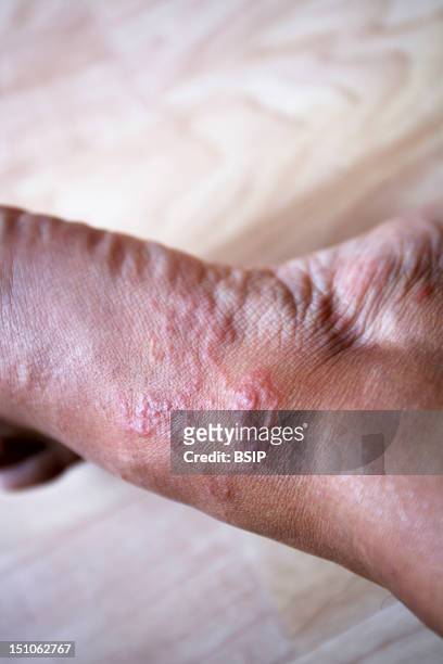 Cutaneous Larva Migrans Or Creeping Eruption Caused By The Anguillula Larvae.