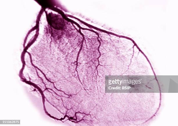 Heart Angiography Visualizing The Morphology Of The Right And Left Coronary Arteries.