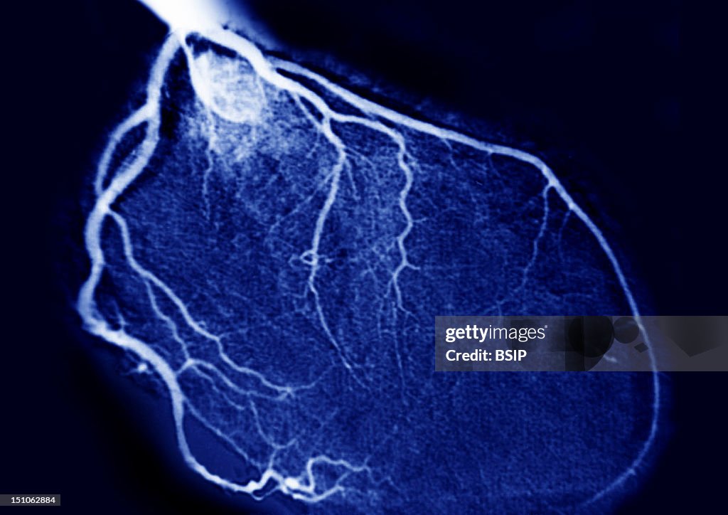 Heart, Angiography