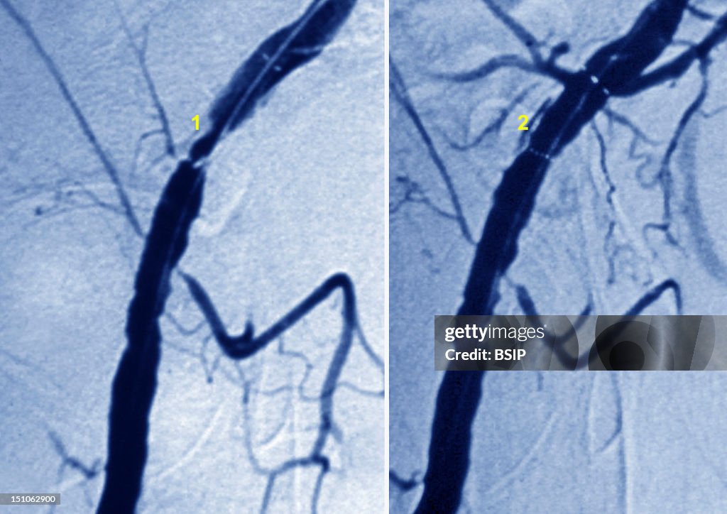 Iliac Stenosis, Angioplasty
