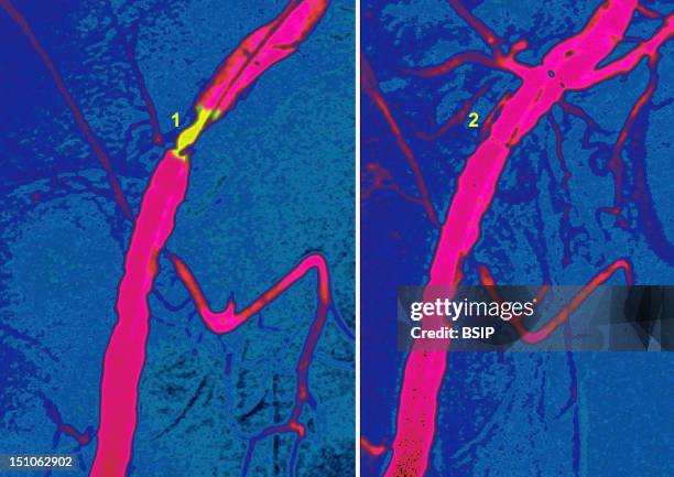 Angioplasty Of An Iliac Artery By Inflation Of A Baloon Catheter 2, In The Stenosed Area Of The Artery 1 Angiography Of The Right Iliac Area.