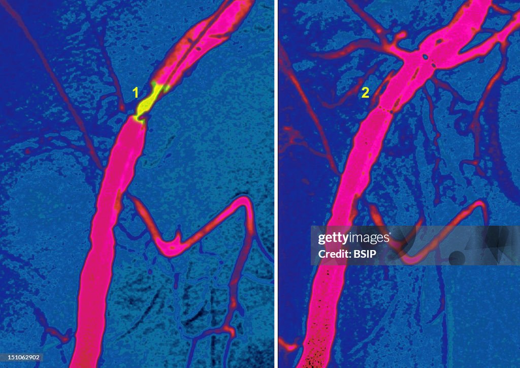 Iliac Stenosis, Angioplasty