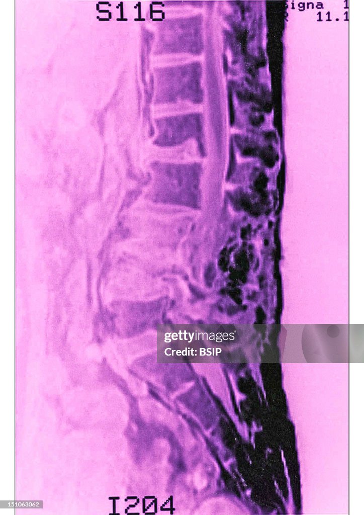 Compression Fracture, Mri