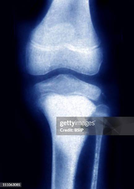 Osteosarcoma Of The Upper Part Of The Tibia With A Rupture Of The Cortical Bone. X Ray Of The Left Knee In Front View.