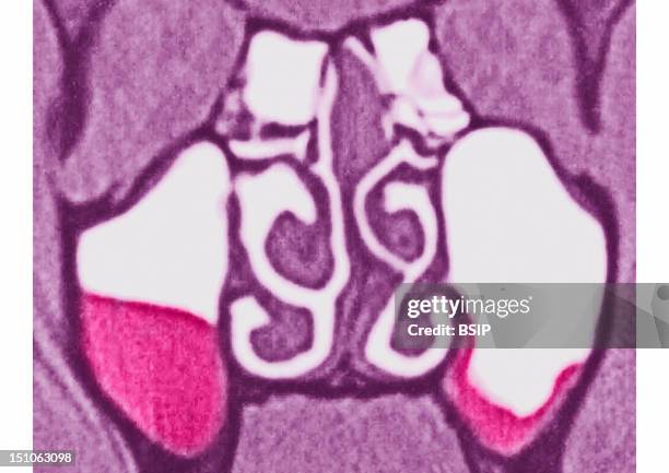 Maxillary Sinusitis. Mri Of The Skull In Frontal Section.