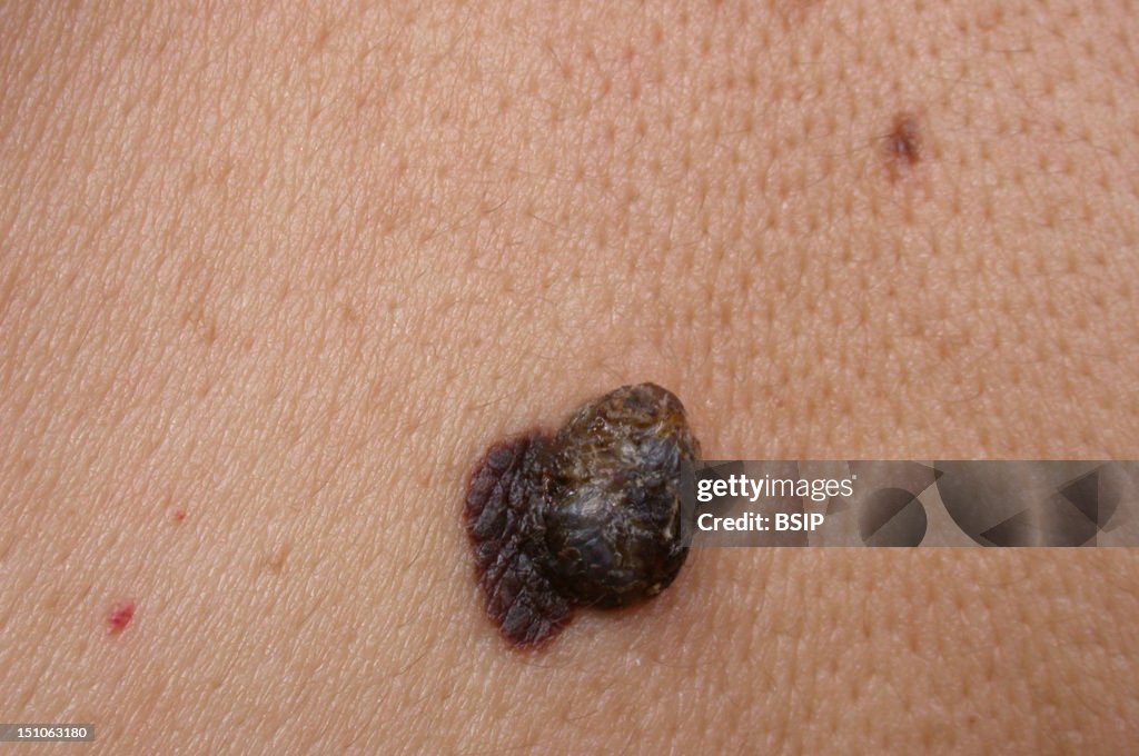Breslow Melanoma At The Level Of The Back. Breslow = 3. 54 Mm. Breslow's ...