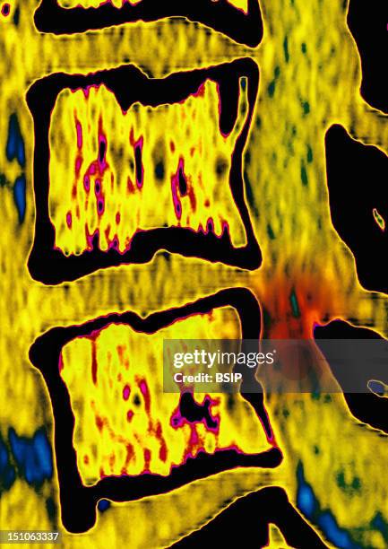 Lumbar Scanner In Saggital Section. Medullar Compression At The Level Of The Lumbar Vertebra L5, Causing A Lumbago And A Sciatic.