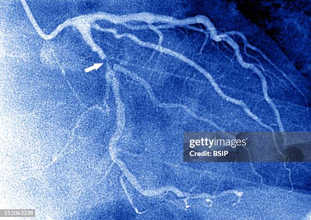 Angiography. Myocardial Infarction Left Coronary Artery Stenosed By Atheroma Plaques.