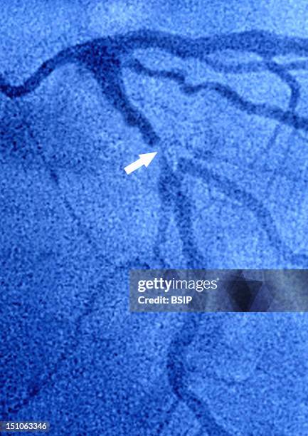 Angiography. Myocardial Infarction Left Coronary Artery Stenosed By Atheroma Plaques.