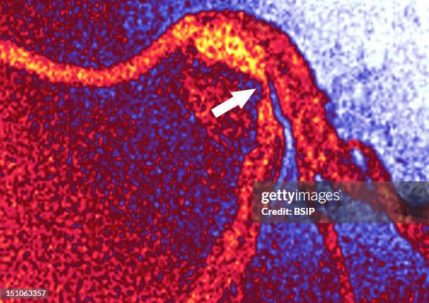 Angiography. Myocardial Infarction Left Coronary Artery Stenosed By Atheroma Plaques.