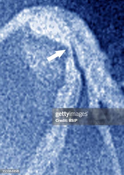 Angiography. Myocardial Infarction Left Coronary Artery Stenosed By Atheroma Plaques.