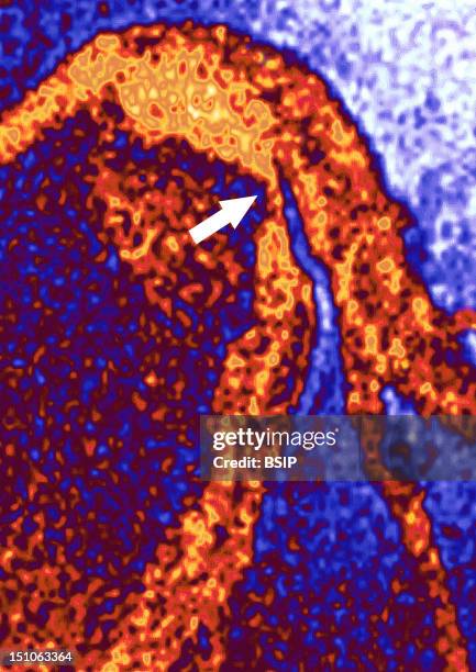 Angiography. Myocardial Infarction Left Coronary Artery Stenosed By Atheroma Plaques.