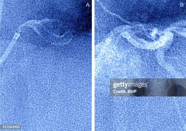 On The Left Artery Stenosed By Atheroma Plaques Myocardial Infarction. On The Right Set Up Of A Stent.