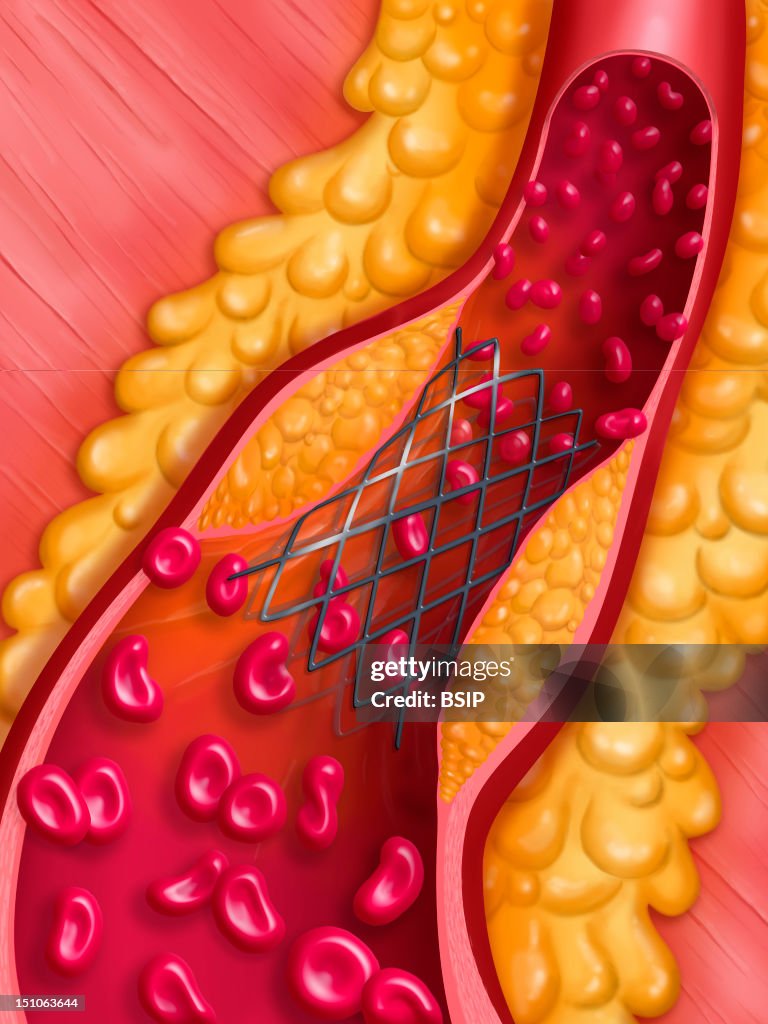 Arterial Angioplasty, Illust.