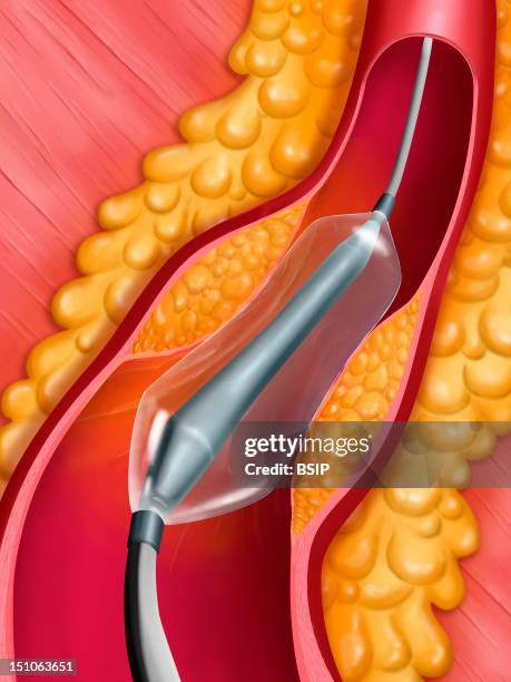 Angioplasty Undertaken With The Help Of A Balloon Catheter And A Stent Inflating Phase Of The Balloon Catheter. Here, Example Of A Coronary Artery.