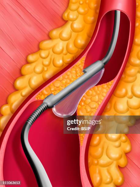 Directional Atherectomy By Simpson Catheter. Made Of A Blade, That Is Constrained By A Ballonnet Catheter, The Plaque Of Atheroma Is Grinded By The...