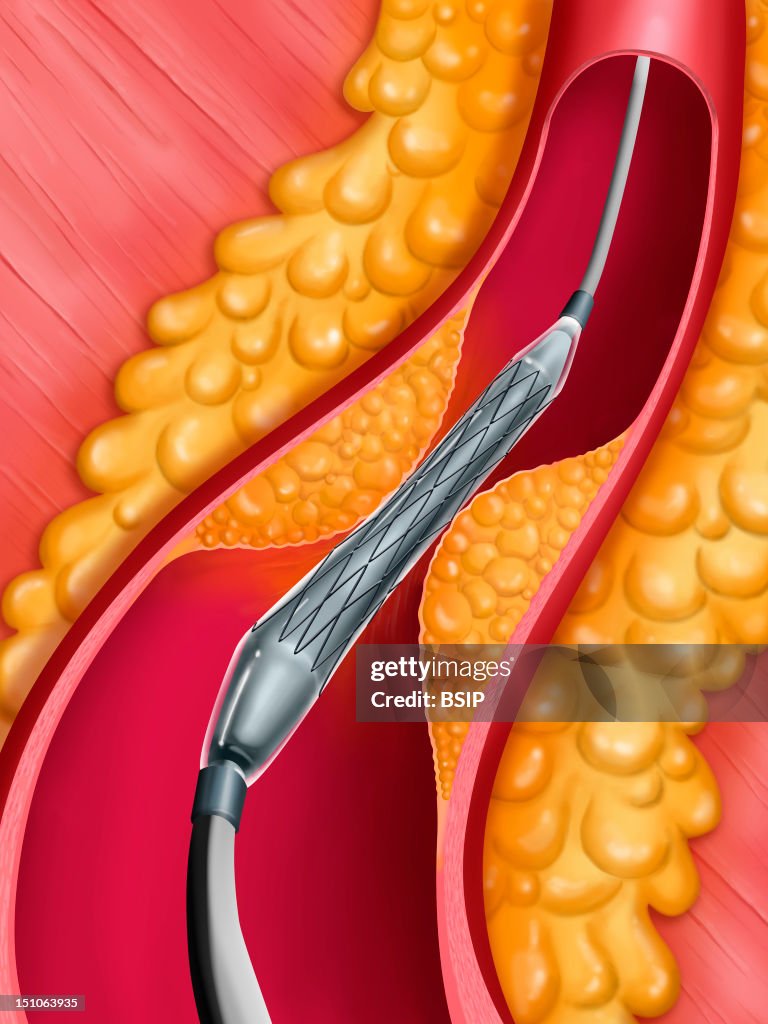 Arterial Angioplasty, Illust.