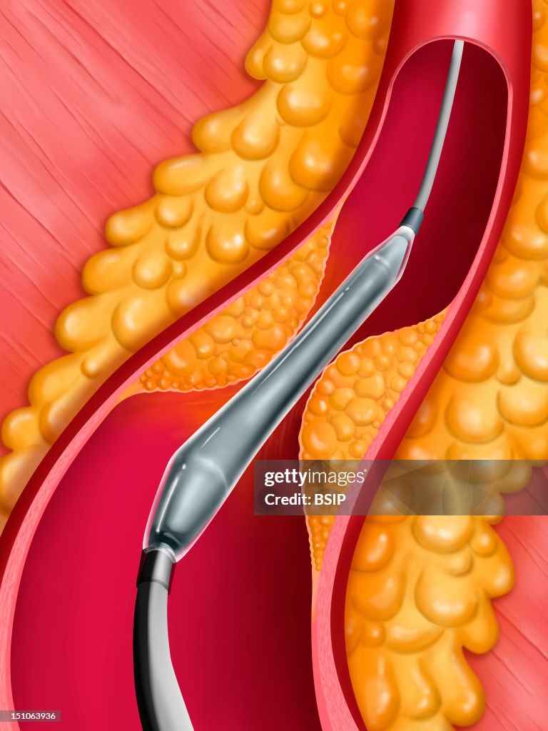 Arterial Angioplasty, Illust.