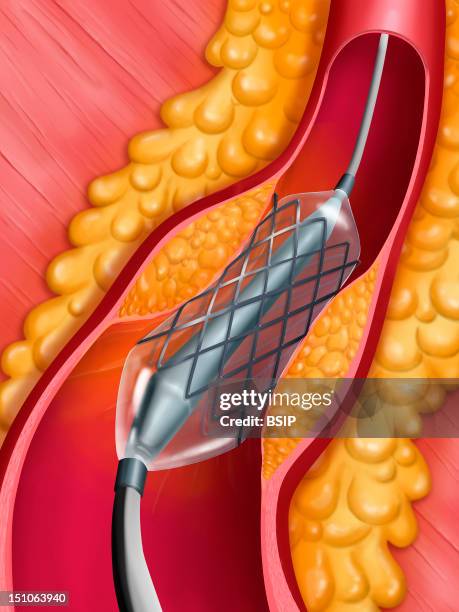 Angioplasty Undertaken With The Help Of A Balloon Catheter And A Stent Inflating Phase Of The Balloon Catheter And Stent Deployment. Here, Example Of...