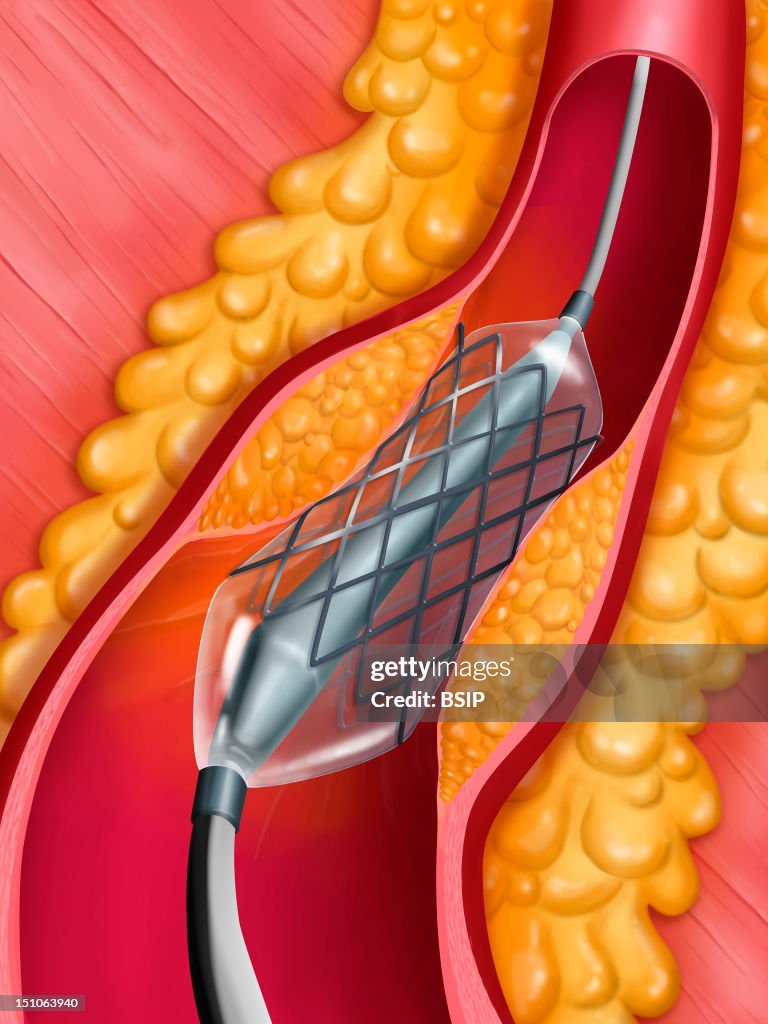 Arterial Angioplasty, Illust.