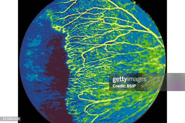 Retinopathy In Premature Infant. Retinal Fluorescein Angiogram Showing Hypoxia Of The Retinal Periphery. Recolorized, Black And White Image.