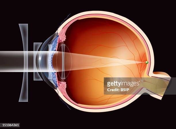 ader gisteren heelal 117 Intraocular Lens Photos and Premium High Res Pictures - Getty Images