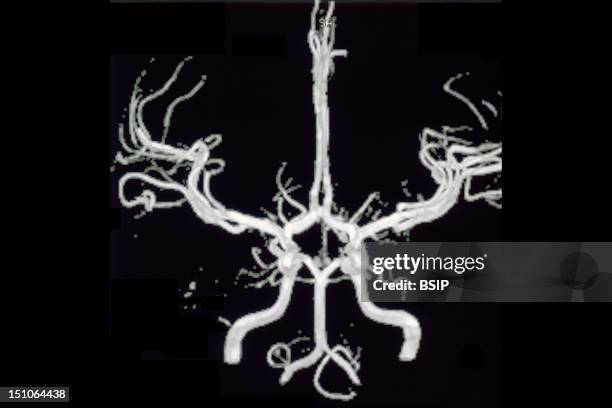 Department Of Morphological And Functional Imaging, Led By Professor Fredy, At The Pitie Salpetriere Hospital In Paris, France. The Circle Of Willis...