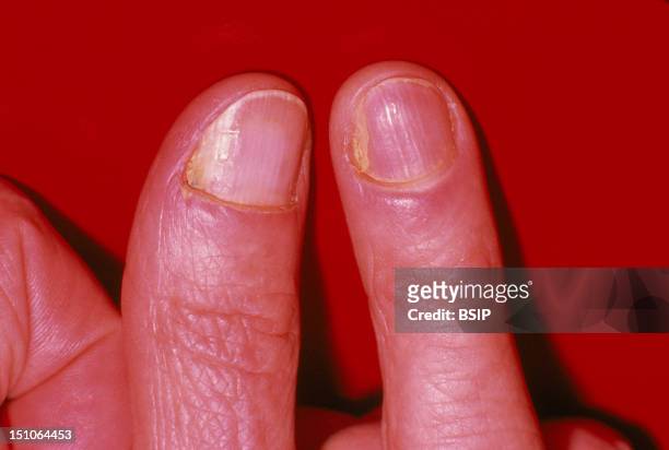 Fungal Nail Infection Caused By Candida Albicans.