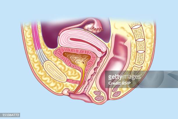 The Pubic Symphysis, Sphincter Urethrae, Clitoris, Labia Minora, Urethra, Meatus Urethral Opening, Vagina, Anal Sphincter, Anus, Rectum, Sacrum,...