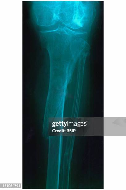 Tibia Quebrada Tibia Fracture Photos and Premium High Res Pictures - Getty Images