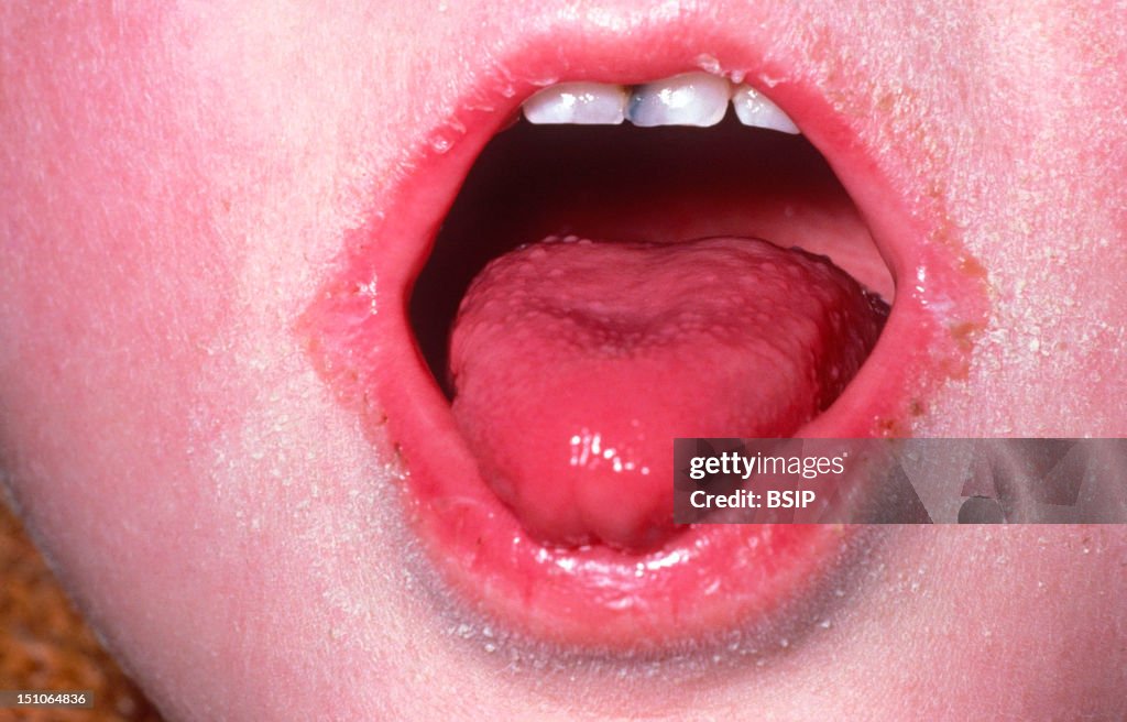 Scarlet Fever