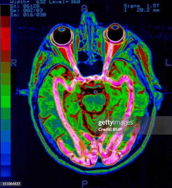 Brain, Mri