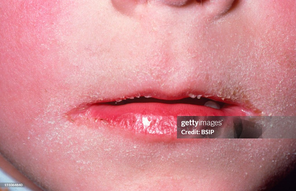 Scarlet Fever