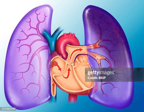 Pulmonary Embolism. A Blood Clot Arrives At The Heart And Is Sent, With The Blood Flow, Towards The Lungs. Being Too Big To Circulate Into The Blood...