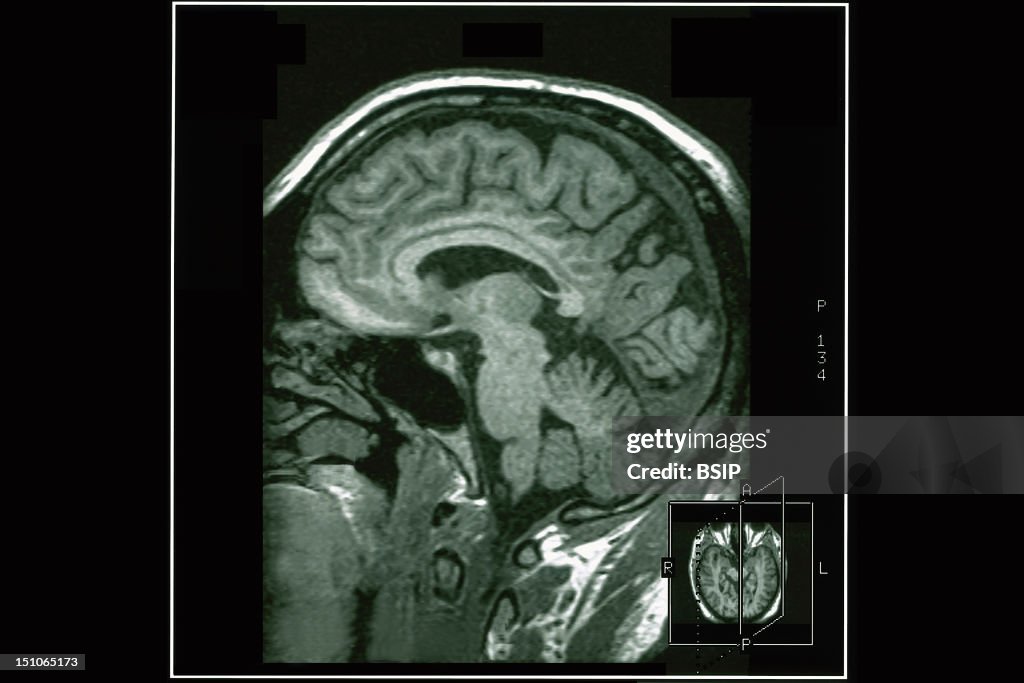 Memory, Mri