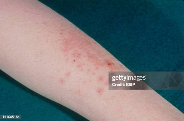 Photodermatitis Rash Photodermatitis Photos and Premium High Res Pictures - Getty Images
