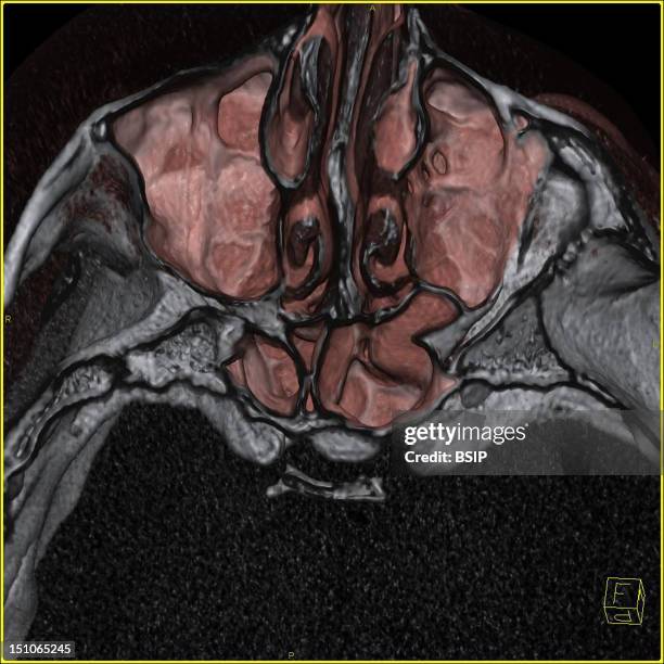 Nasal Septum Is Visible, As Well As Pneumatic Cavities In The Sphenoid, Ethmoid, And Maxillary Bones. 3D Ct Scan. The Icon At The Bottom Right...