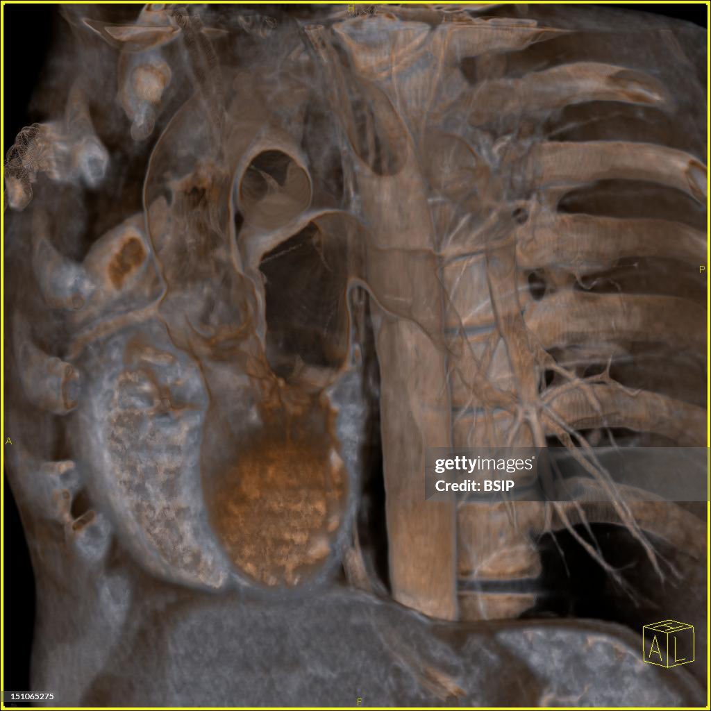 Thorax, Scan