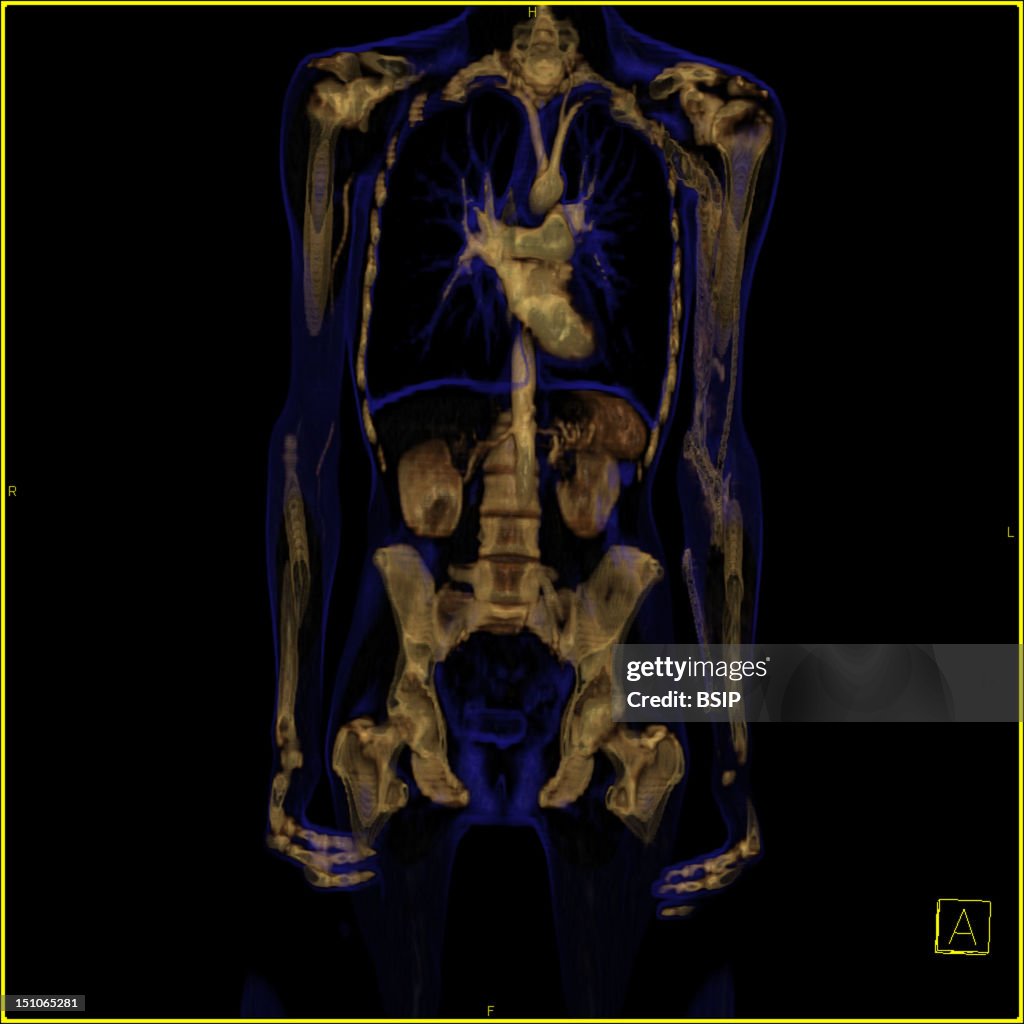Ct Scanner Front View Rendered Entire Body, Frontal View. 3D Ct Scan. The Icon At The Bottom Right ...