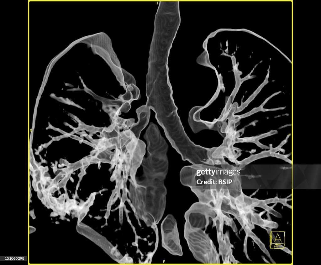 Thorax, Scan