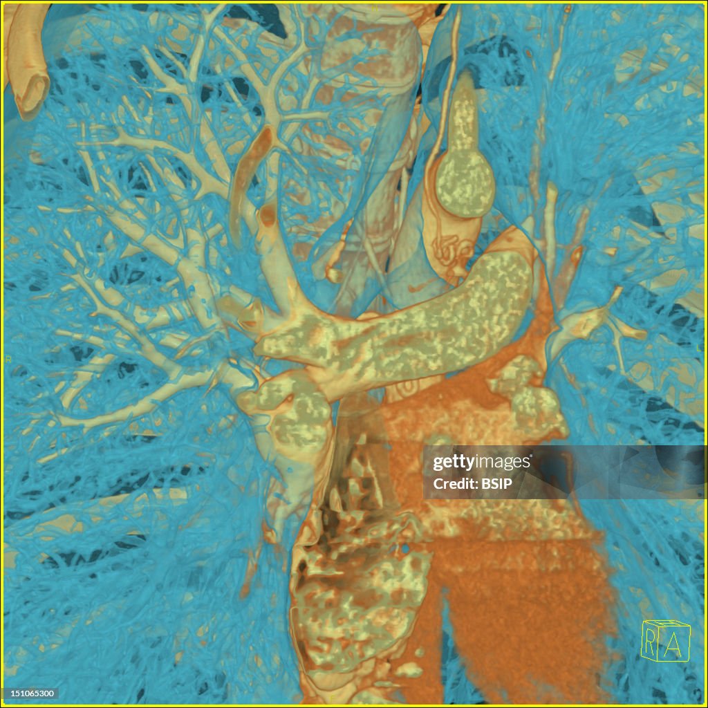 Thorax, Scan
