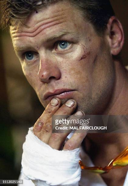 Kingsley footballer Damon Brimson from the Perth, Australia suburbs is seen with stitches in his hand and burns on his back in Denpasar, Bali, 14...