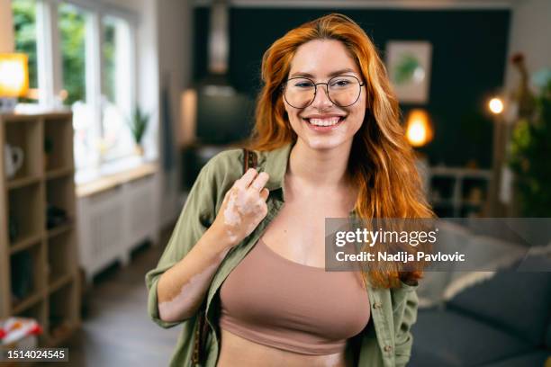 portrait of young redhead caucasian woman with vitiligo and acne - autoimmune disease stock pictures, royalty-free photos & images