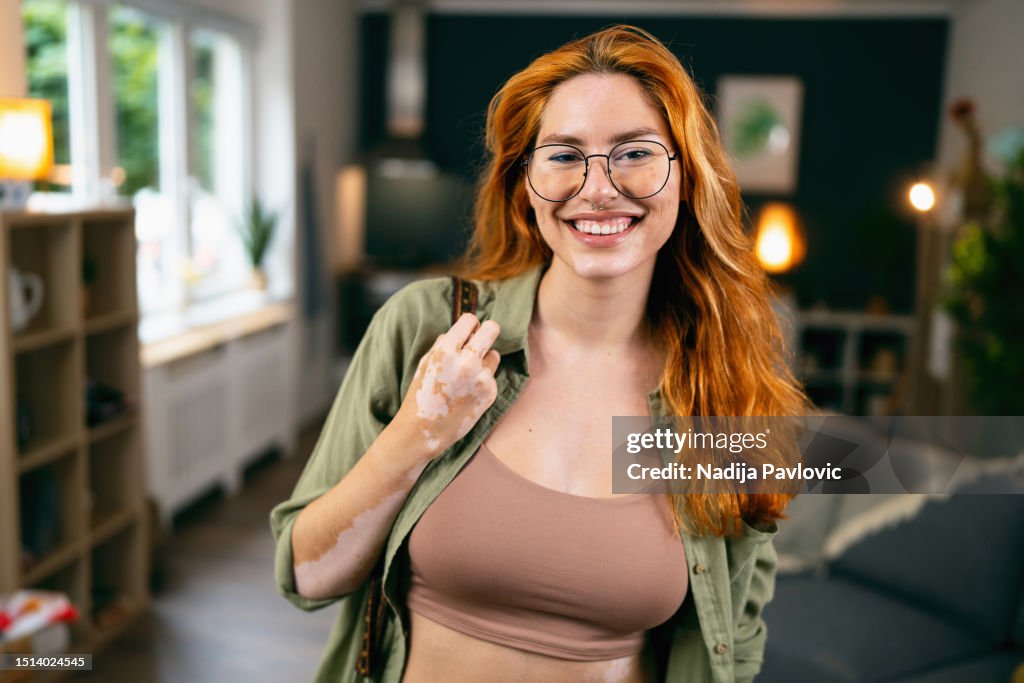 Retrato da mulher branca ruiva jovem com vitiligo e acne