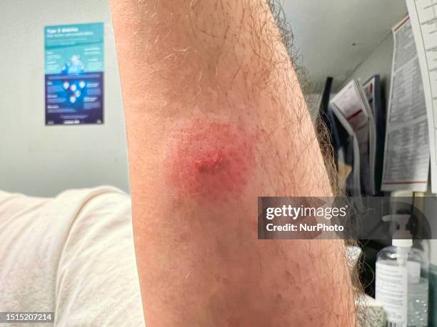 Tick bite on the forearm of a man in Toronto, Ontario, Canada, on July 07, 2023. Experts predict bad year for ticks as disease-carrying bugs expand...