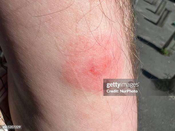 Tick bite on the forearm of a man in Toronto, Ontario, Canada, on July 07, 2023. Experts predict bad year for ticks as disease-carrying bugs expand...