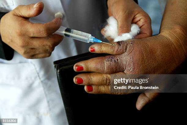 An Afghan woman gets treated for Leishmaniasis on her hand with an injection of Pentostam at the Health Net Clinic October 23, 2002 in Kabul,...