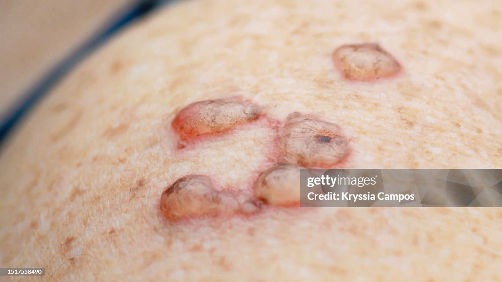 Skin Blisters in Shoulder After Cryotherapy
